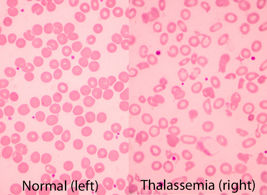 The Chemistry of Cooley's Anemia