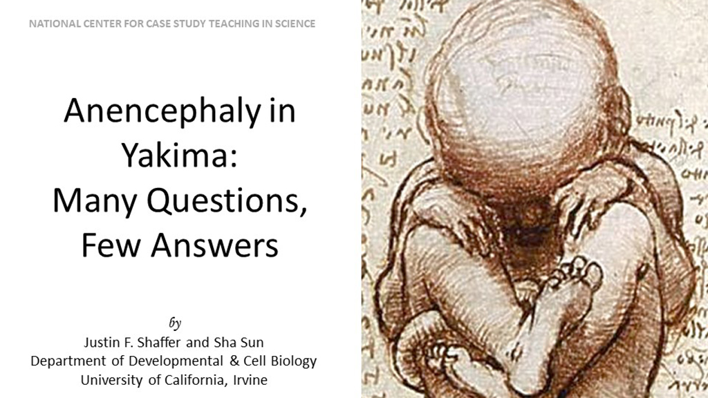 Anencephaly in Yakima