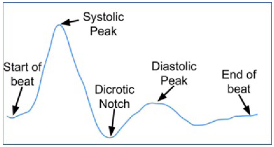 PPG with key features labeled.