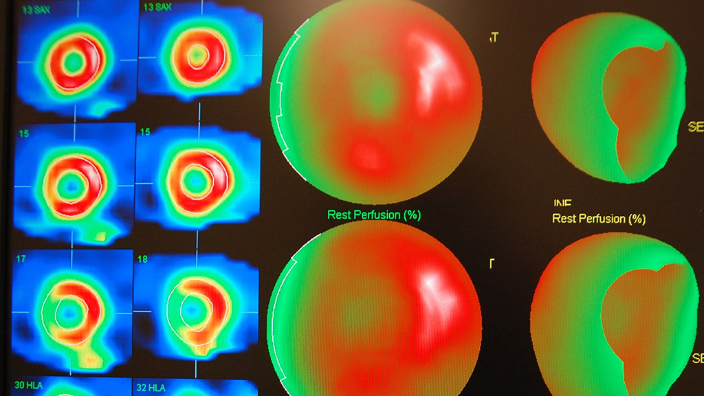 Cardiac Imaging Using a Radioisotope