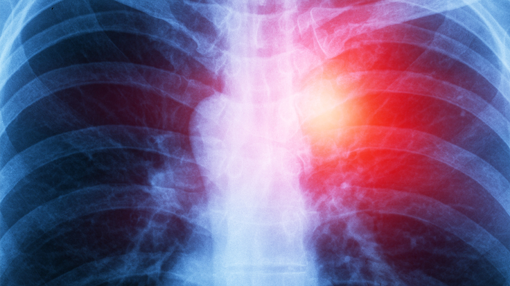 How does where you live and work affect your risk of mesothelioma?