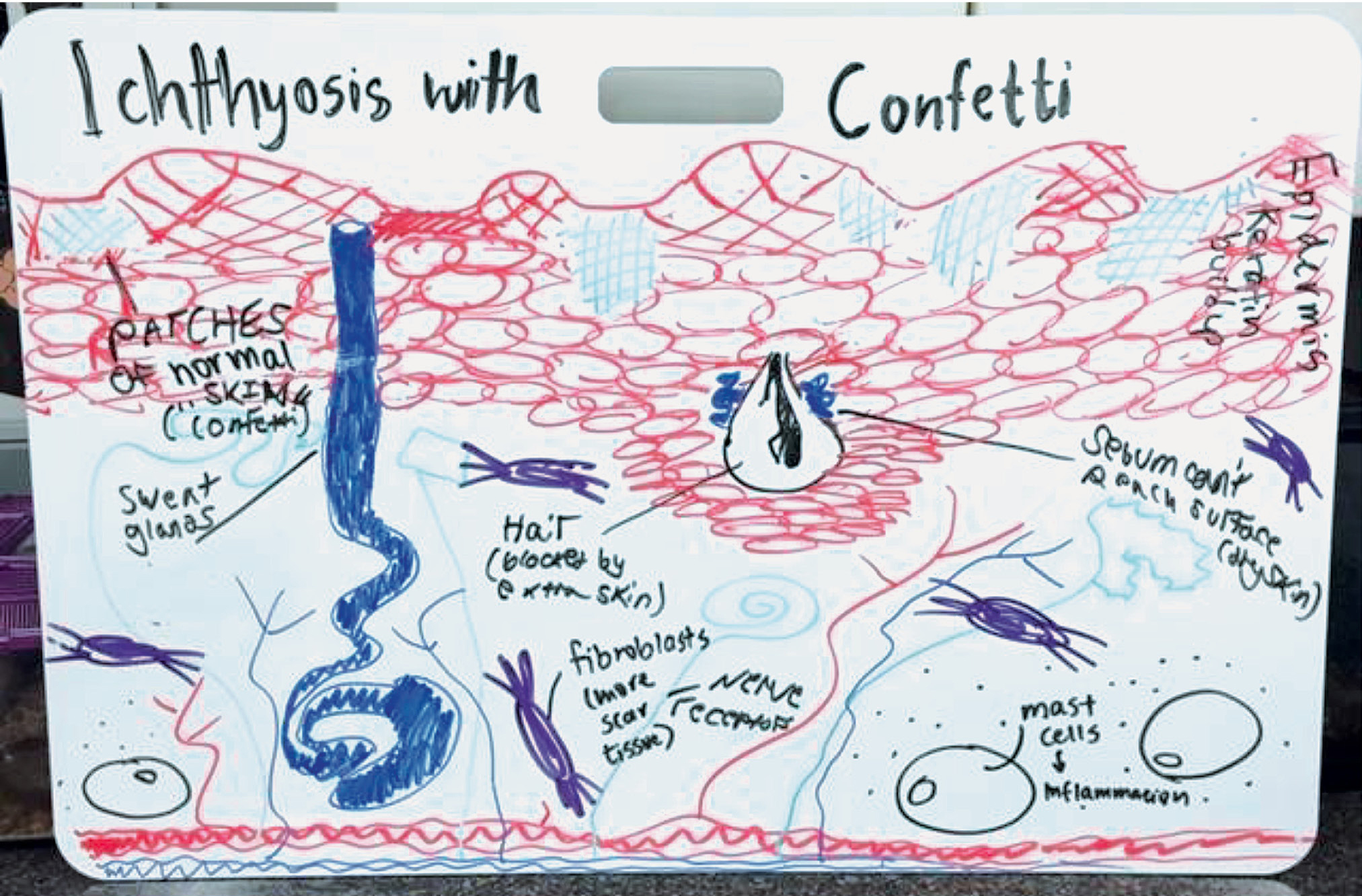 Figure 2 The hypothesis and modeling of the cause and effect of a skin condition called “Ichthyosis with Confetti” by a group of four students.
