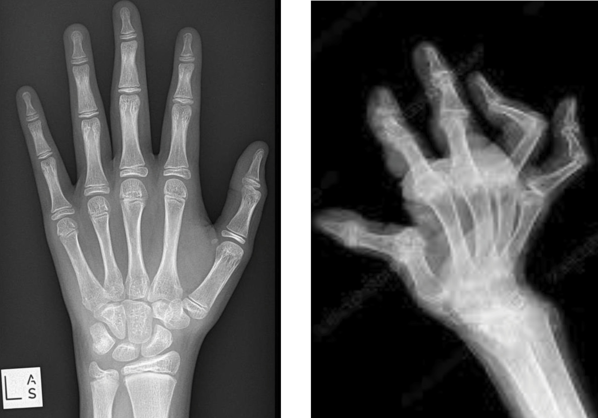 (L) Skeleton of a normal hand (www.radiopaedia.org); (R) Skeleton of an arthritic hand (www.radiopaedia.org).